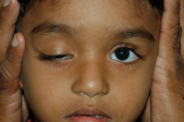 Paediatric Eye Care