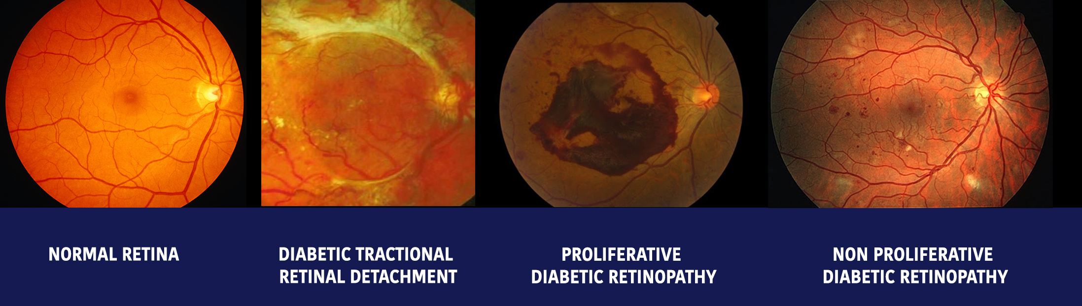 Diabetic Retinopathy - Gupta Eye Hospital