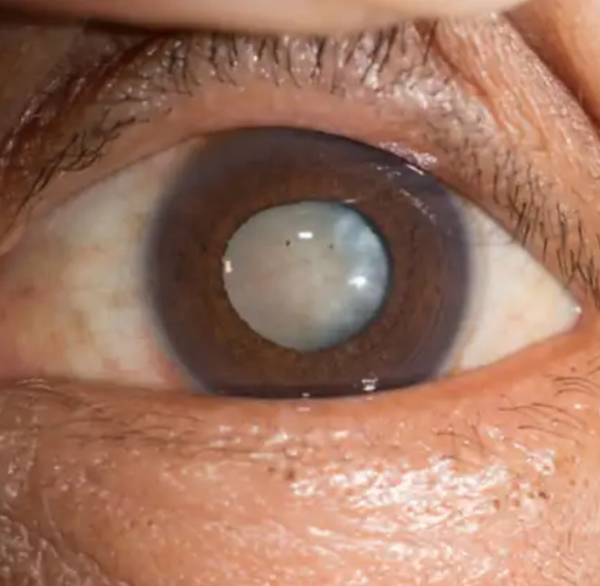 Cataract in eye depiction, Milky/cloudy formation in eye | Gupta Eye Hospital - Panipat