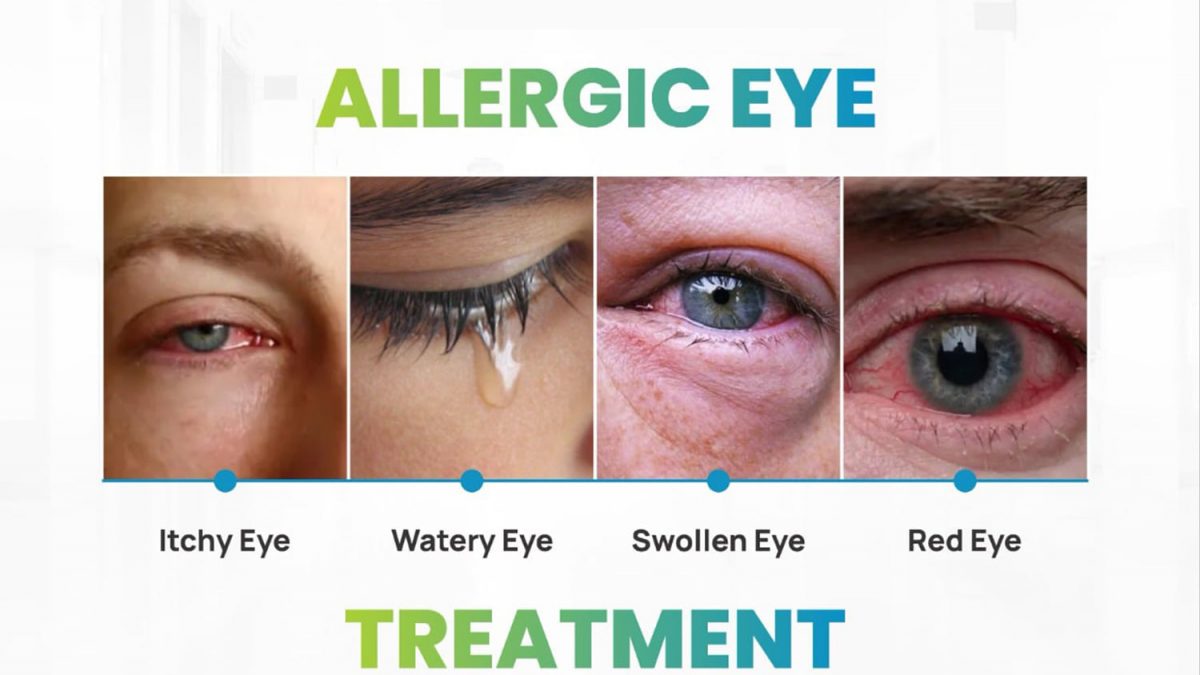 Treatment of Allergic Eye in Panipat | Gupta Eye Hospital
