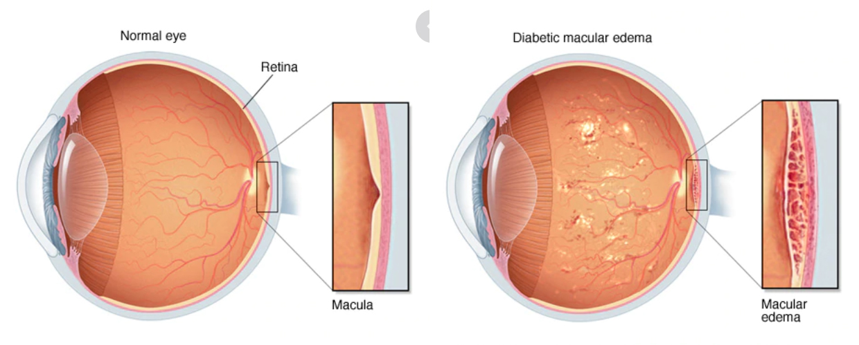 Diabetic Macular Edema Eye | Gupta Eye Hospital