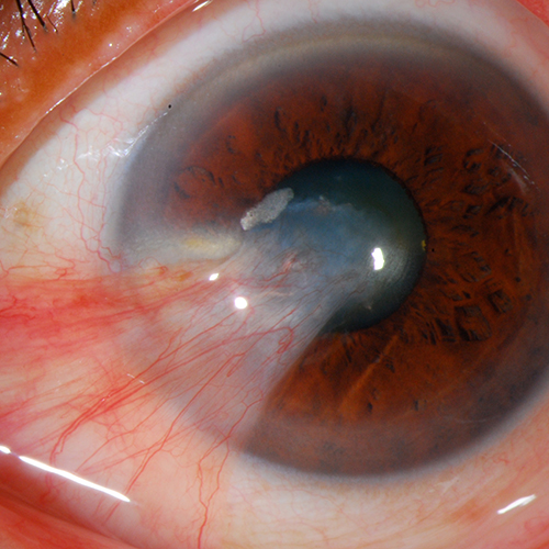 Pterygium