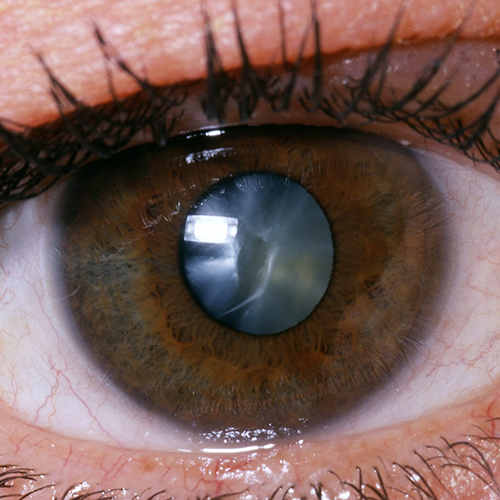 cataract-service