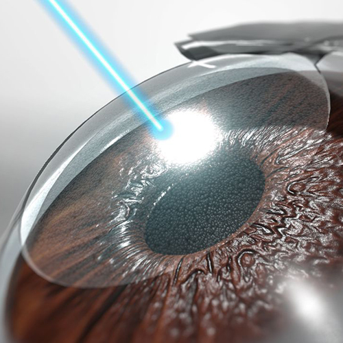 lasik